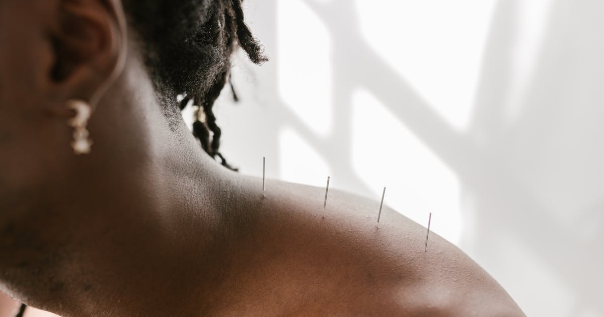 Bienfaits de l'Acupuncture pour la Santé